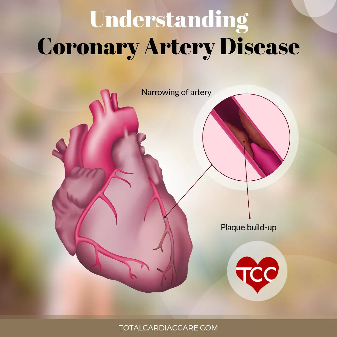 Illustration: Understanding coronary artery disease. An anatomical heart with a cutaway of a coronary artery, labelled narrowing of artery and plaque build-up.