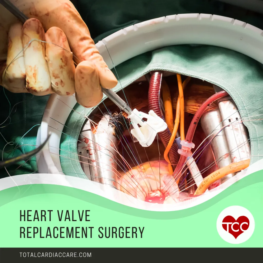 Poster: Heart valve replacement surgery. A photograph of an open-heart operation in progress, with retractors and sutures in place.