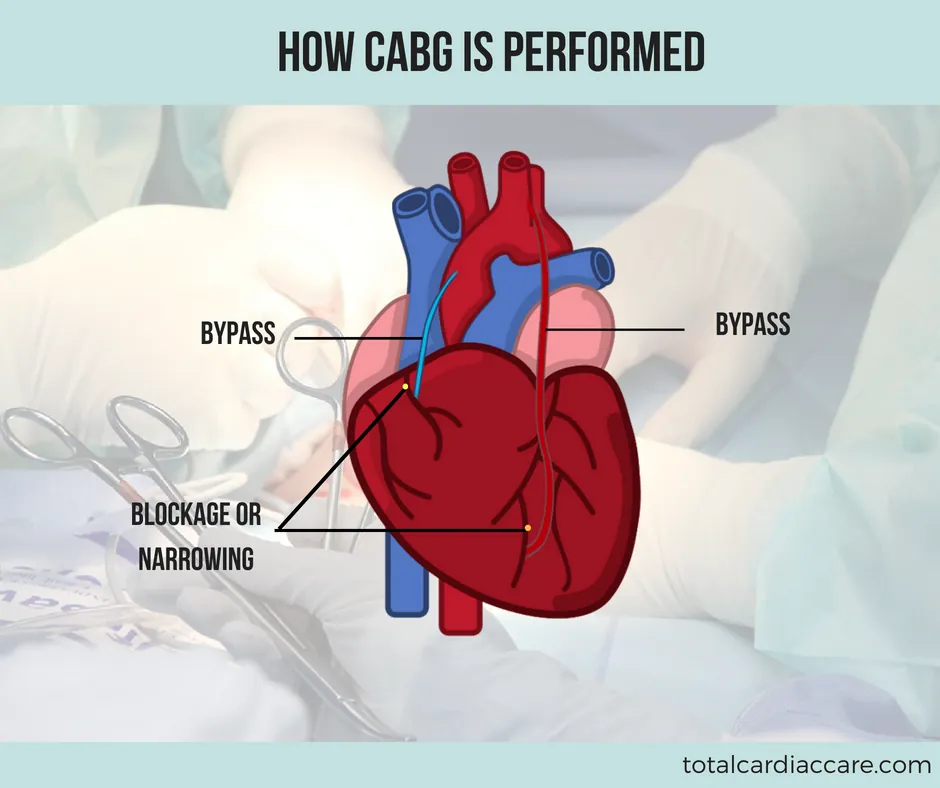 Diagram: How CABG is performed. A heart with two grafted bypass vessels labelled bypass, routed around a point labelled blockage or narrowing.