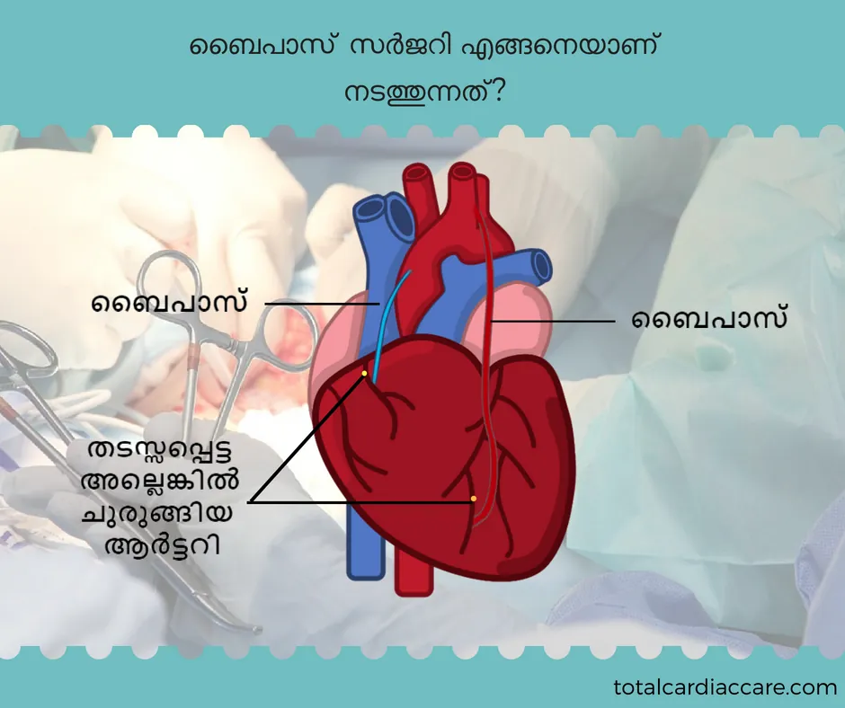 The same bypass diagram labelled in Malayalam: the grafted bypass vessels, and the blocked or narrowed artery they route around.