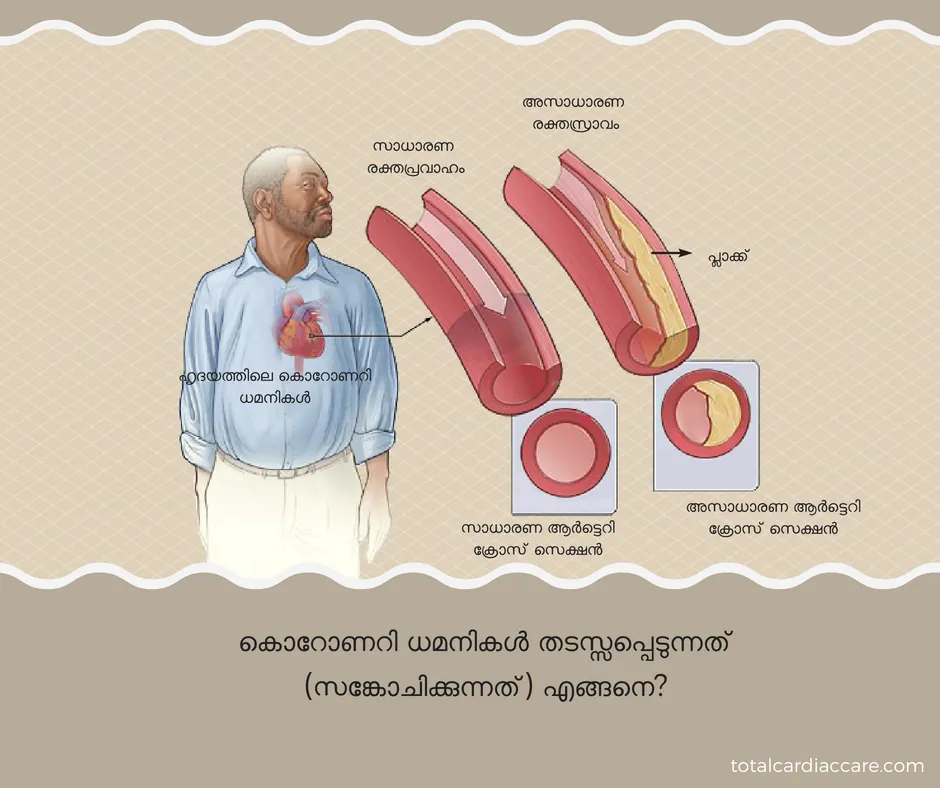 Diagram in Malayalam: how a coronary artery becomes blocked. A man with the coronary arteries on the surface of the heart marked, beside cross-sections of a normal artery and one narrowed by plaque.