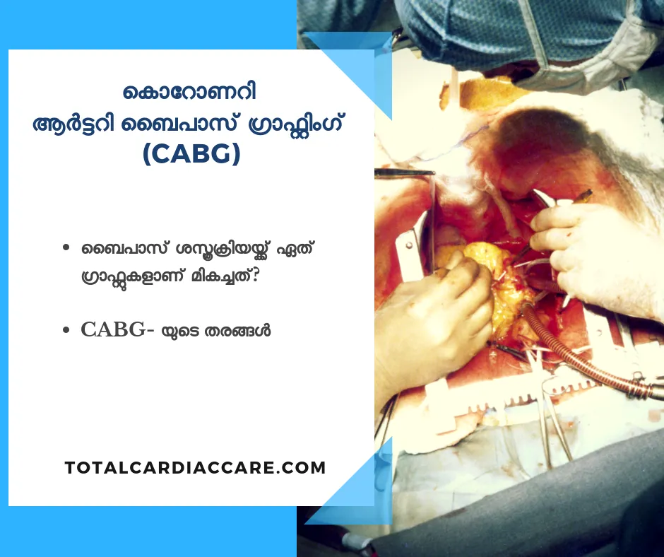 The same CABG title card in Malayalam, asking which grafts are best in bypass surgery and listing the types of CABG.