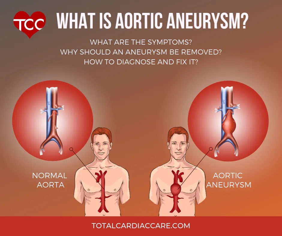 Illustration: What is aortic aneurysm. What are the symptoms, why should an aneurysm be removed, how to diagnose and fix it. A normal aorta shown beside an aorta with an aneurysm.