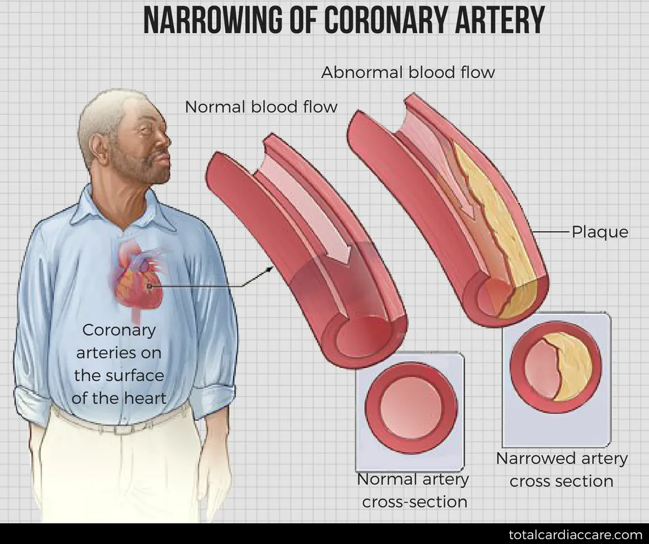 Diagram: Narrowing of a coronary artery. A man with the coronary arteries on the surface of the heart marked, showing normal blood flow, abnormal blood flow past a plaque, and cross-sections of a normal and a narrowed artery.