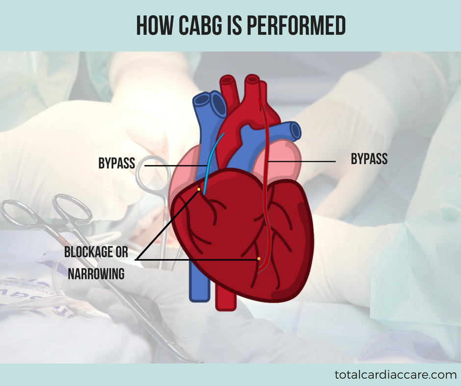 How Is Cabg Performed Total Cardiac Care Dr Mahadevan